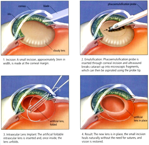 cataract surgery cataracts eye blind animation treat but removed then